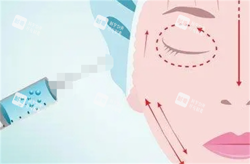 玻尿酸面部填充示意图.png 玻尿酸面部填充示意图.png
