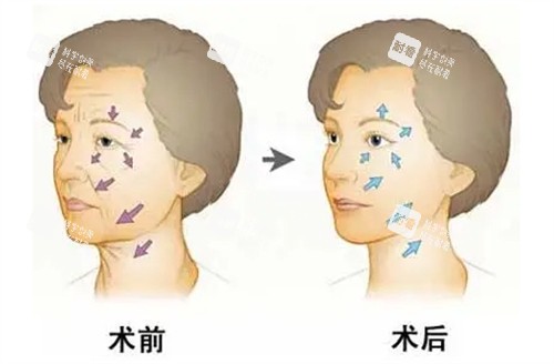 面部年轻化管理前后对比.jpg