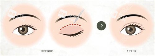 双眼皮术对比宣传图.jpg