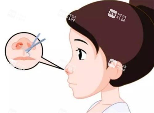 隆鼻切口的位置图解.jpg