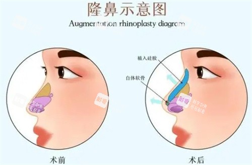 隆鼻前后对比.jpg