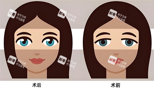 双眼皮术后术前对比动画图.jpg 双眼皮术后术前对比动画图.jpg