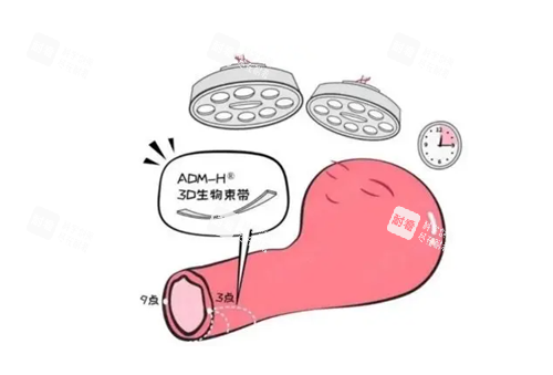 3d生物束带缩阴.png