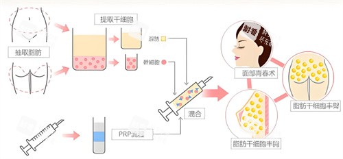 自体脂肪隆胸过程.jpg 自体脂肪隆胸过程.jpg