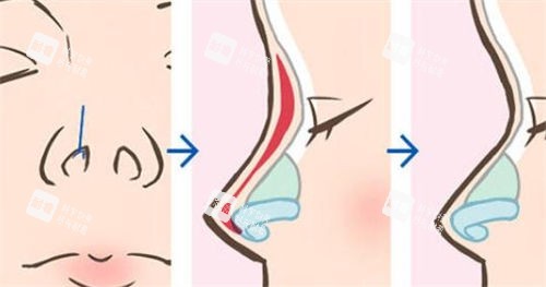鼻部综合隆鼻术前术后展示图.jpg