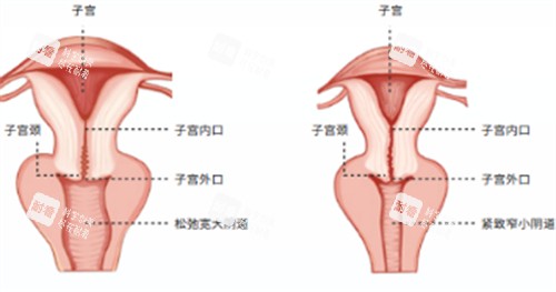 阴道紧缩术施术位置图解.jpg 阴道紧缩术施术位置图解.jpg
