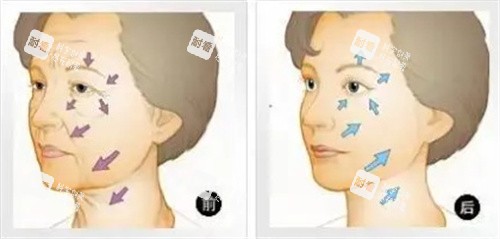 面部抗衰对比图.jpg