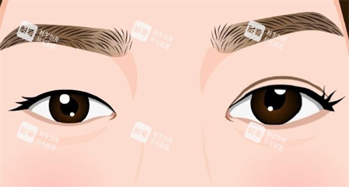 双眼皮手术术前术后对比卡通.jpg 双眼皮手术术前术后对比卡通.jpg