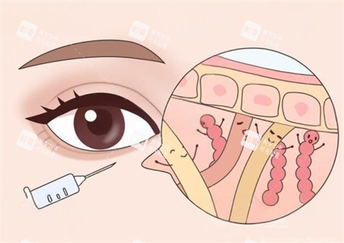 眼周抗衰注射卡通图.jpg 眼周抗衰注射卡通图.jpg