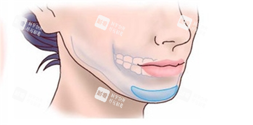 假体垫下巴面部透视图.png 假体垫下巴面部透视图.png