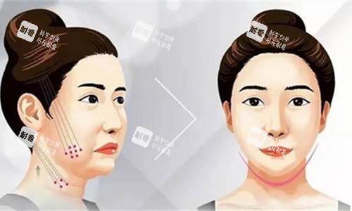 埋线提升卡通图.jpg 埋线提升卡通图.jpg