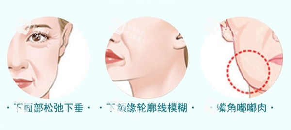 适合埋线提升的情况.jpg 适合埋线提升的情况.jpg