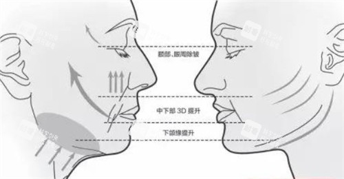 面部提升前后各个部位的对比.jpg 面部提升前后各个部位的对比.jpg