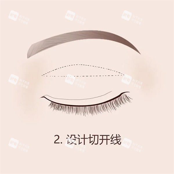 双眼皮手术.jpg