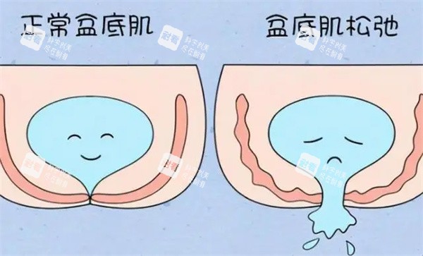 盆底肌修复图片.jpg 盆底肌修复图片.jpg