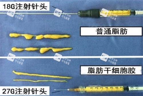 自体脂肪填充需要的脂肪提纯后的样子图片.jpg