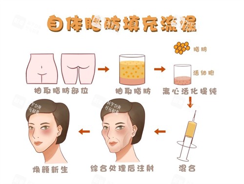 面部自体脂肪填充流程演示动画图.jpg