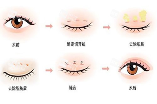 切开式双眼皮过程.jpg