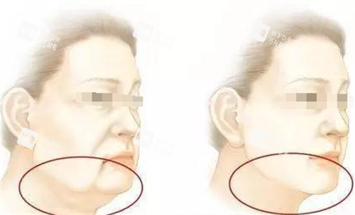 微拉美面部提升动画前后对比图.png