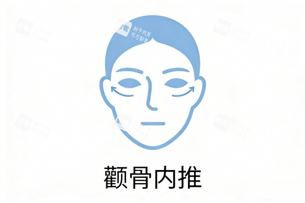 颧骨内推图片展示.jpg 颧骨内推图片展示.jpg