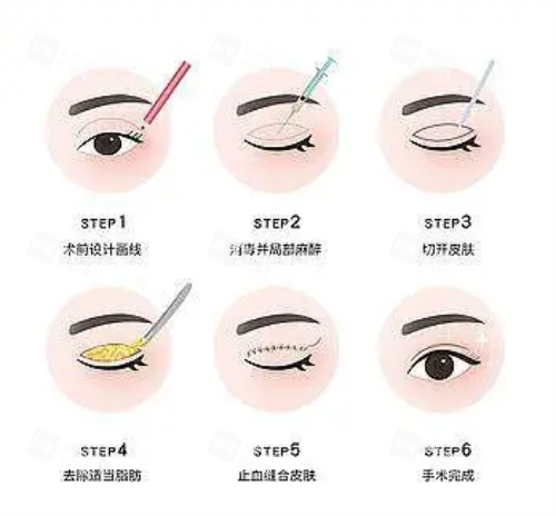 全切双眼皮流程图示.png 全切双眼皮流程图示.png