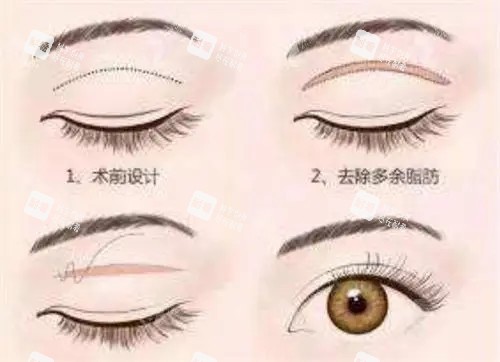 全切双眼皮卡通示意图.jpg 全切双眼皮卡通示意图.jpg