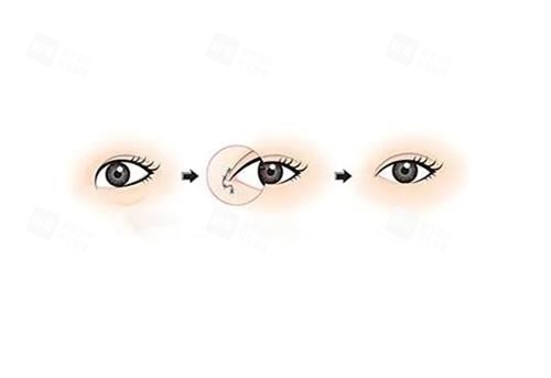 开眼角手术前后对比图.png 开眼角手术前后对比图.png