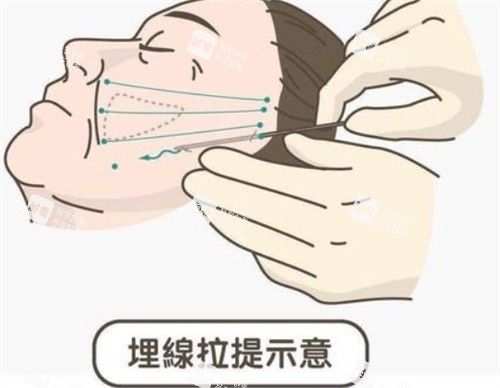 埋线提升面部的操作过程.jpg 埋线提升面部的操作过程.jpg