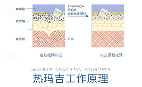 热玛吉工作示意图.jpg