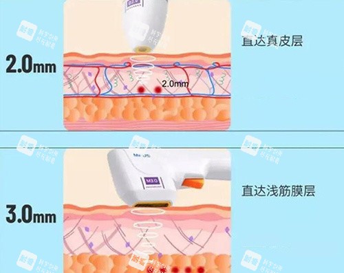 半岛超声炮探头展示图.jpg 半岛超声炮探头展示图.jpg