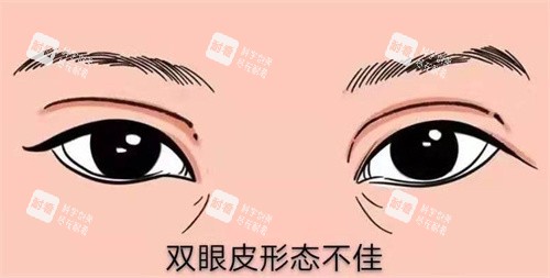 修复双眼皮.jpg 修复双眼皮.jpg