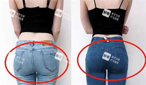 臀部吸脂手术背面对比图.jpg