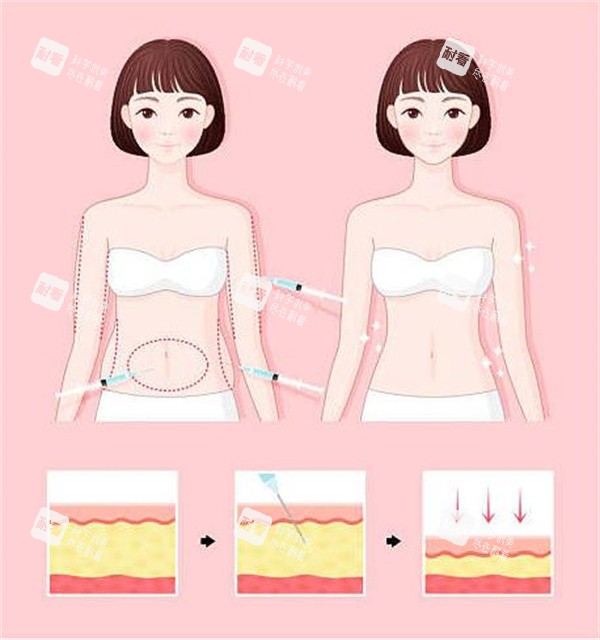 腰腹吸脂对比.jpg