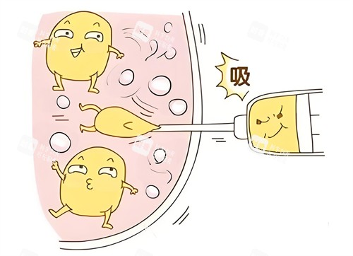 吸脂.jpg