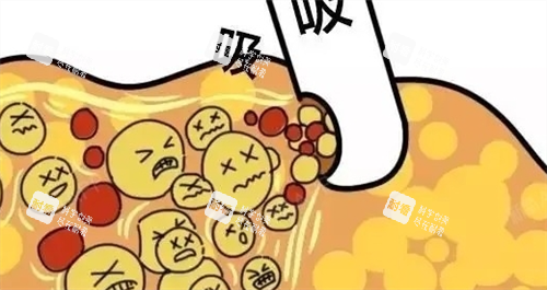 吸脂过程动画展示图.png
