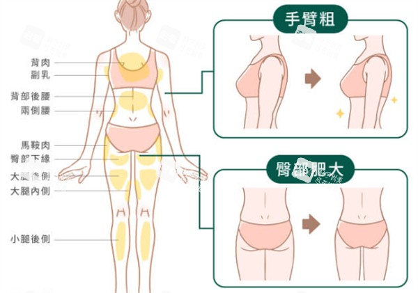 吸脂部位解析.jpg