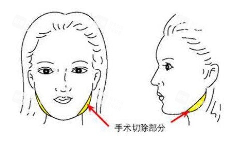 面部磨骨手术示意图.jpg 面部磨骨手术示意图.jpg