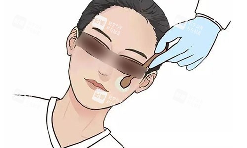 光子嫩肤示意图.jpg