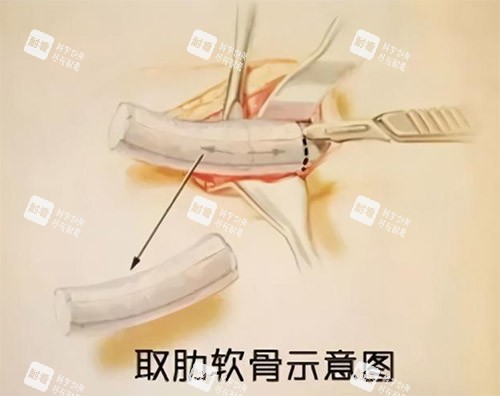 肋骨鼻手术过程图.jpg