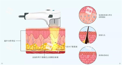 超声炮原理.jpg 超声炮原理.jpg