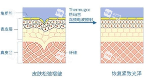 热玛吉作用在皮肤上皮下组织展示.png 热玛吉作用在皮肤上皮下组织展示.png