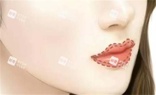 丰唇唇部画线填充图.png