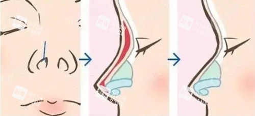 鼻整形图片.JPG 鼻整形图片.JPG