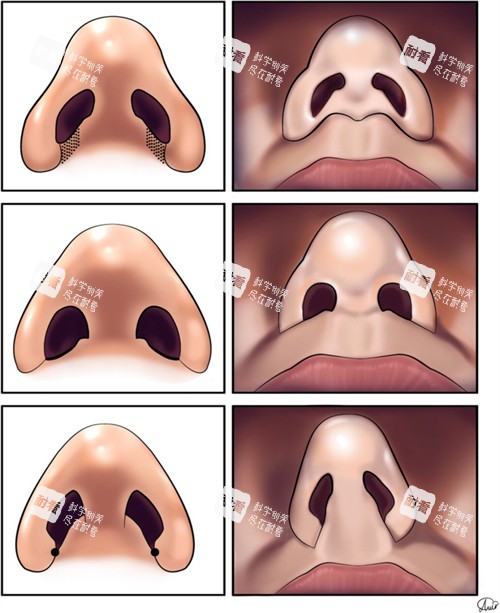 鼻整形的对比.jpg 鼻整形的对比.jpg