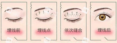 埋线双眼皮过程示意图片.jpg