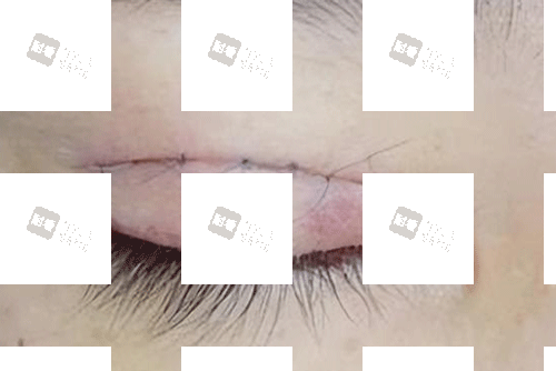 双眼皮疤痕明显照片.png