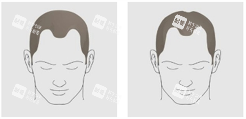 发际线后移类型.png 发际线后移类型.png