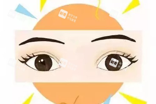 成功双眼皮示意图.jpg 成功双眼皮示意图.jpg