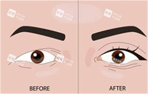 双眼皮手术前后对比.jpg 双眼皮手术前后对比.jpg