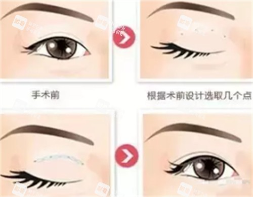 贝塞尔双眼皮手术过程图解.jpg 贝塞尔双眼皮手术过程图解.jpg